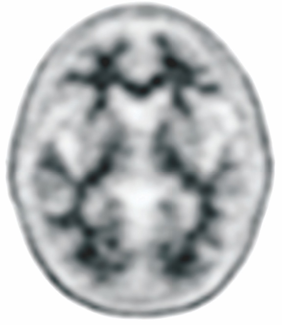 Brain negative Amyvid PET scan