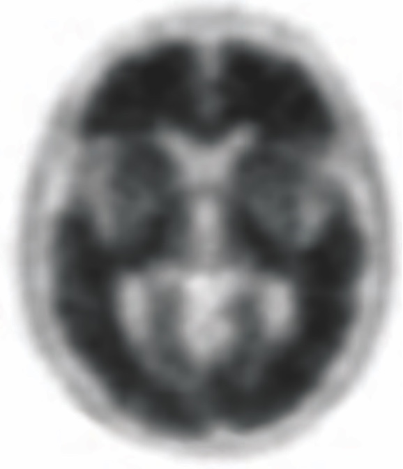 Brain positive Amyvid PET scan