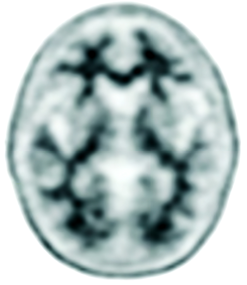 Negative Amyvid brain PET scan
