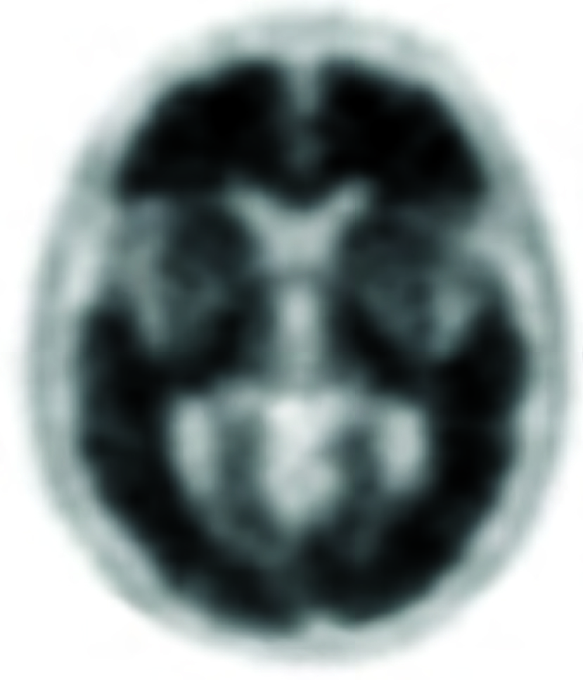 Positive Amyvid brain PET scan